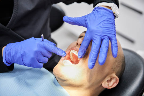 Best Emergency Wisdom Tooth Extraction in Brookston, IN