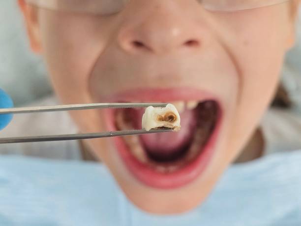 Best Knocked-Out Tooth (Avulsed Tooth) Treatment in Brookston, IN